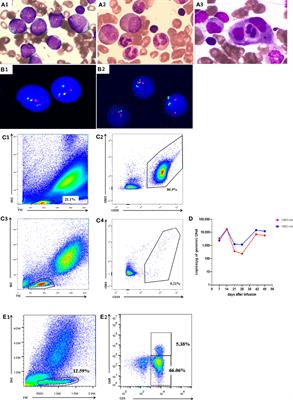 Case Report: Chimeric Antigen Receptor T Cells Induced Late Severe Cytokine Release Syndrome